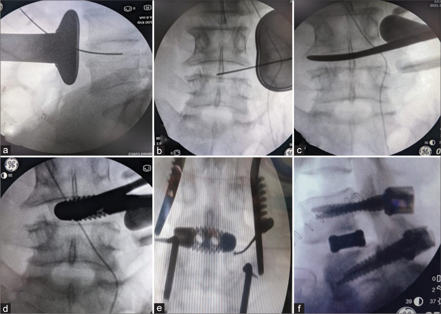 Intra-operative steps of the Wiltse oblique lateral interbody fusion. a-b-The confirmation of level and also the location of guide wire in the part of disc; c-the release of opposite annulus as part of disc space preparation;d- insertion of cage (d);e and f- insertion of pedicle screws.