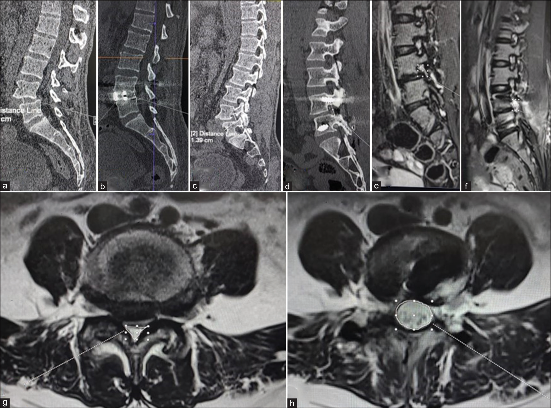 Images demonstrating radiological parameters are measured in a patient who underwent open transforaminal lumbar interbody fusion. The measurement on the computed tomography scans (a and b)- disc height, (c and d)- foramen height; measurement on the magnetic resonance imaging (e and f)-the foramen cross sectional area, (g and h)- spinal cord cross sectional area.