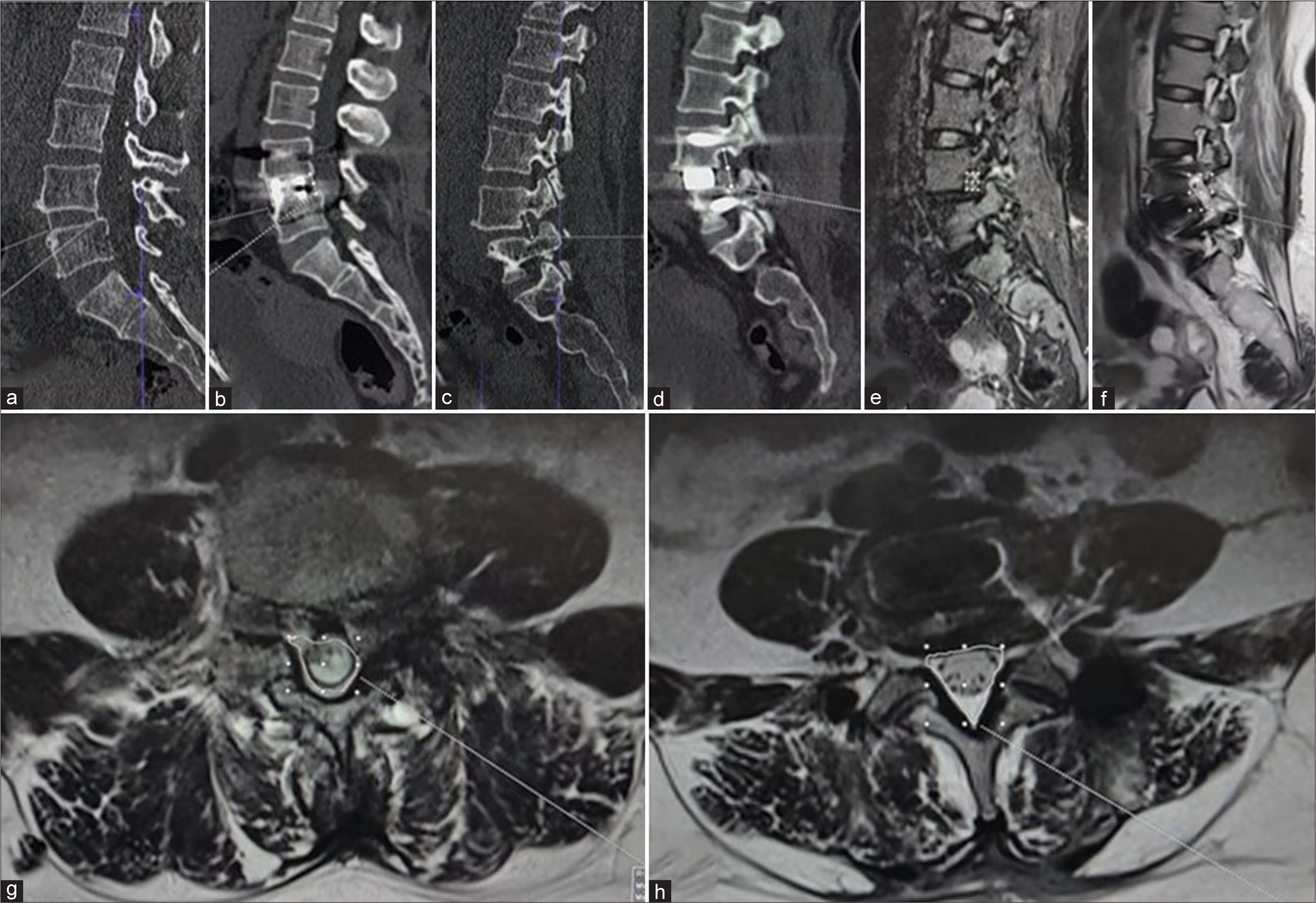 Images demonstrating radiological parameters are measured in a patient who underwent Wiltse oblique lateral interbody fusion. The measurement on the computed tomography scans (a and b)- disc height, (c and d)- foramen height; measurement on the magnetic resonance imaging (e and f)-the foramen cross sectional area, (g and h)- spinal cord cross sectional area.