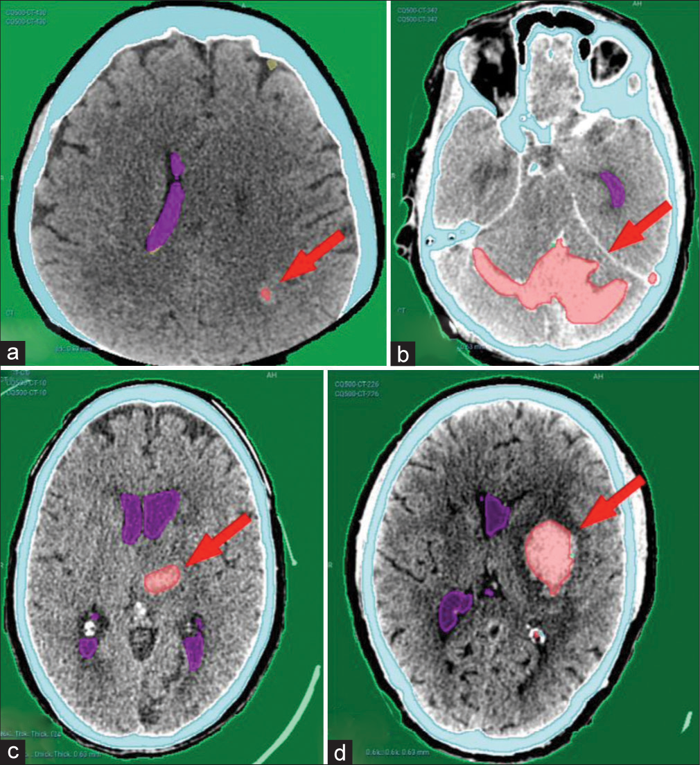 Examples from the CQ500 test dataset showing complete detection of different hematoma locations and sizes. (a) Left parieto-occipital punctate hematoma. (b) Bilateral cerebellar large hematoma. (c) Left thalamic hematoma. (d) Left basal ganglia hematoma. Red arrows pointing to the hematomas.