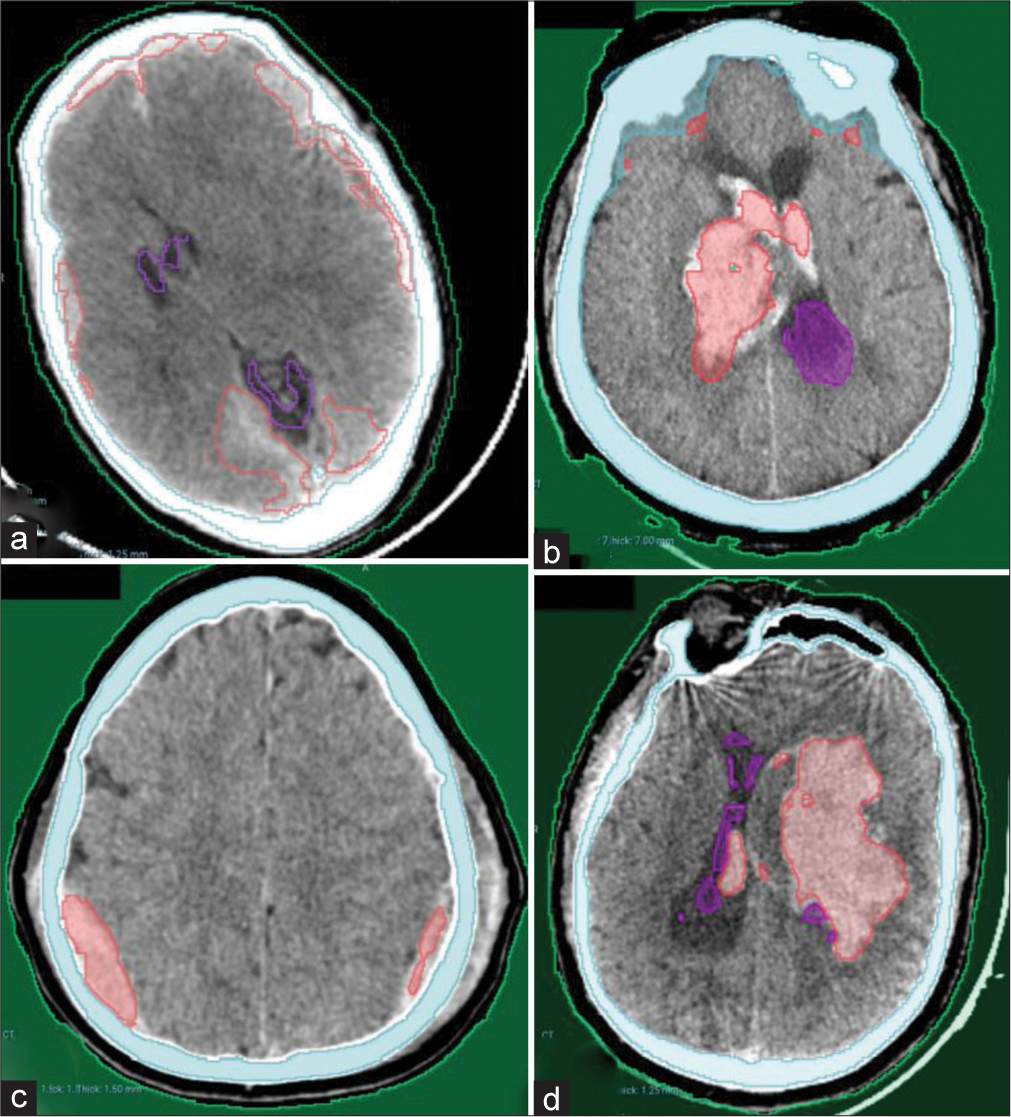 Examples from our local hospital test dataset showing complete detection of different hematoma locations and sizes. (a) Bilateral acute subdural hematomas (b) Right thalamic hematoma with intraventricular extension. (c) Bilateral parietal extradural hematomas. (d) Left large deep intracerebral hematoma with small intraventricular extension.