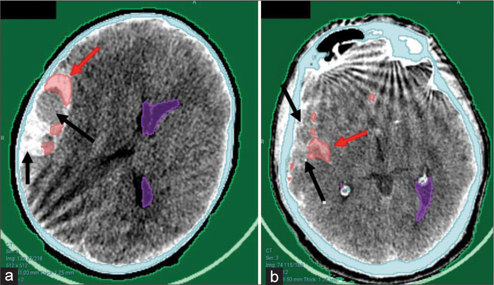 Examples of partial detection of hematomas from the local hospital. (a) Large right temporoparietal hyperacute extradural hematoma. (b) Subarachnoid hemorrhage in the right Sylvian fissure. Note the bony artifacts present. Arrows poiting to hematoma sites. Red arrows referring to successfully detected areas of the hematoma while the black arrows refer to the missed areas.