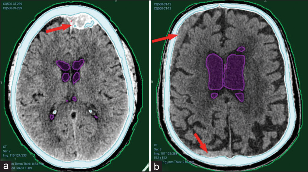 Undetected hematomas from CQ500 dataset. (a) Left frontal old calcified extradural hematoma. Red arrows pointing to the hematomas. (b) Right frontal and occipital subacute subdural hematomas. Red arrows pointing to bleeding sites that were not detected.