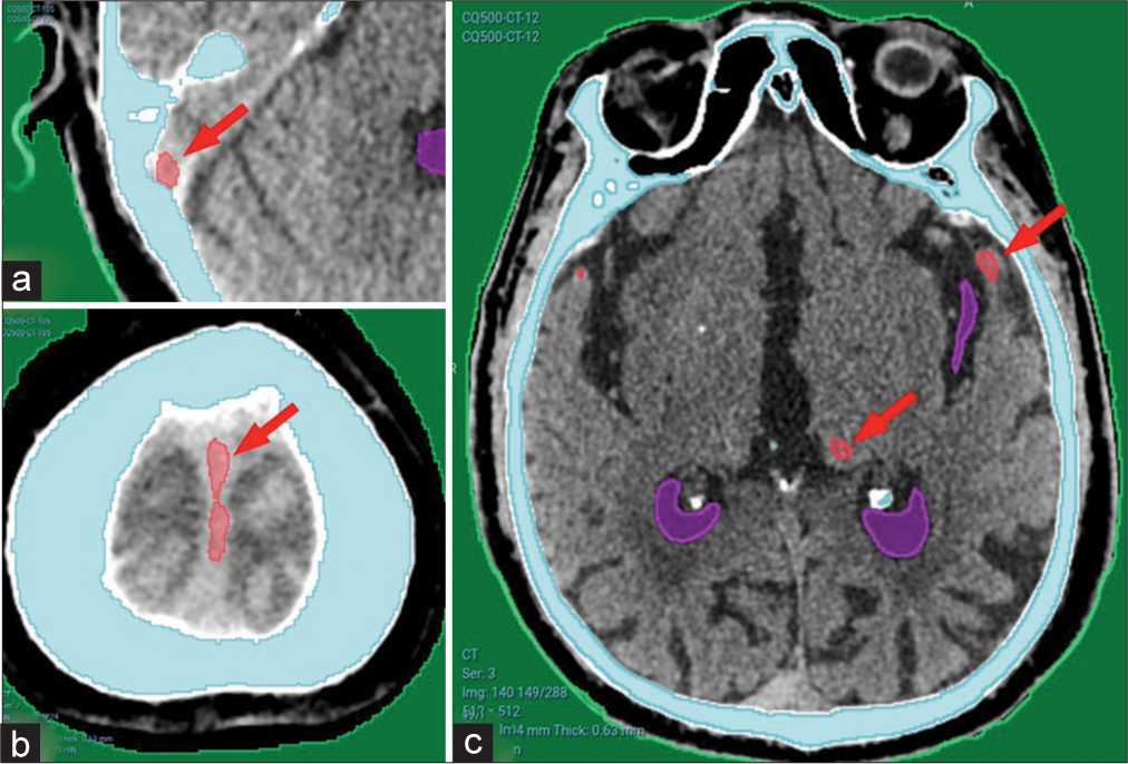 (a) Showing minor false-positive results from CQ500 dataset in the sigmoid sinus, (b) falx cerebri, and (c) basal ganglia calcification. Red arrows pointing to areas falsely detected as hematomas.