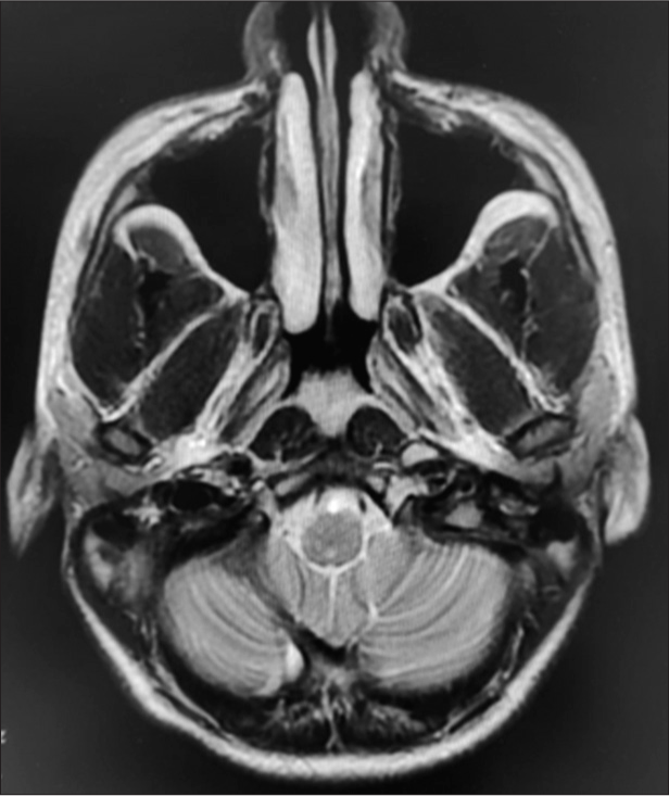 Magnetic resonance imaging brain image of the patient with seizure-myoclonus syndrome.
