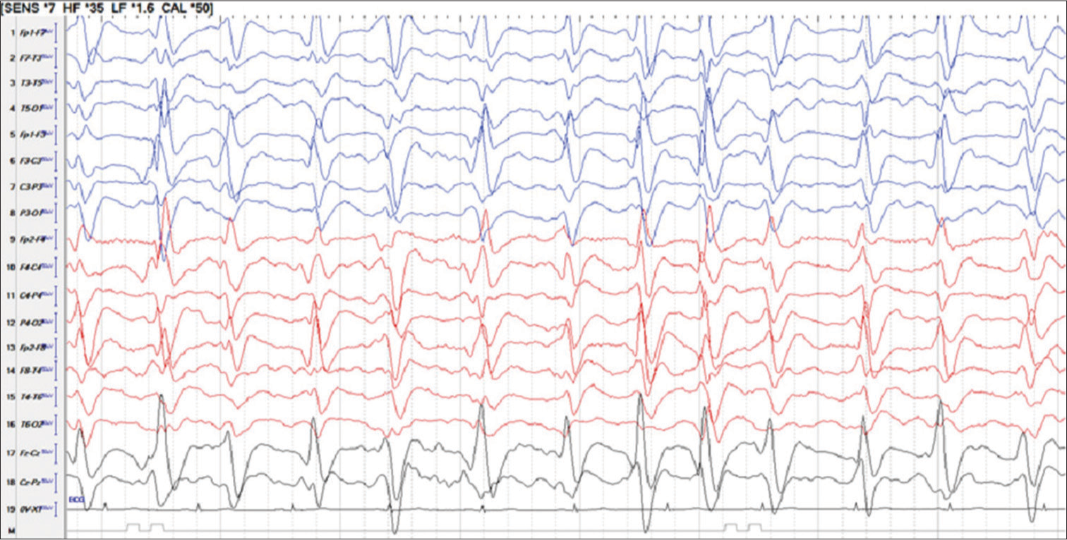 Fifty year man with ethanol related chronic liver disease and hepatic encephalopathy shows generalized 1/s T waves.