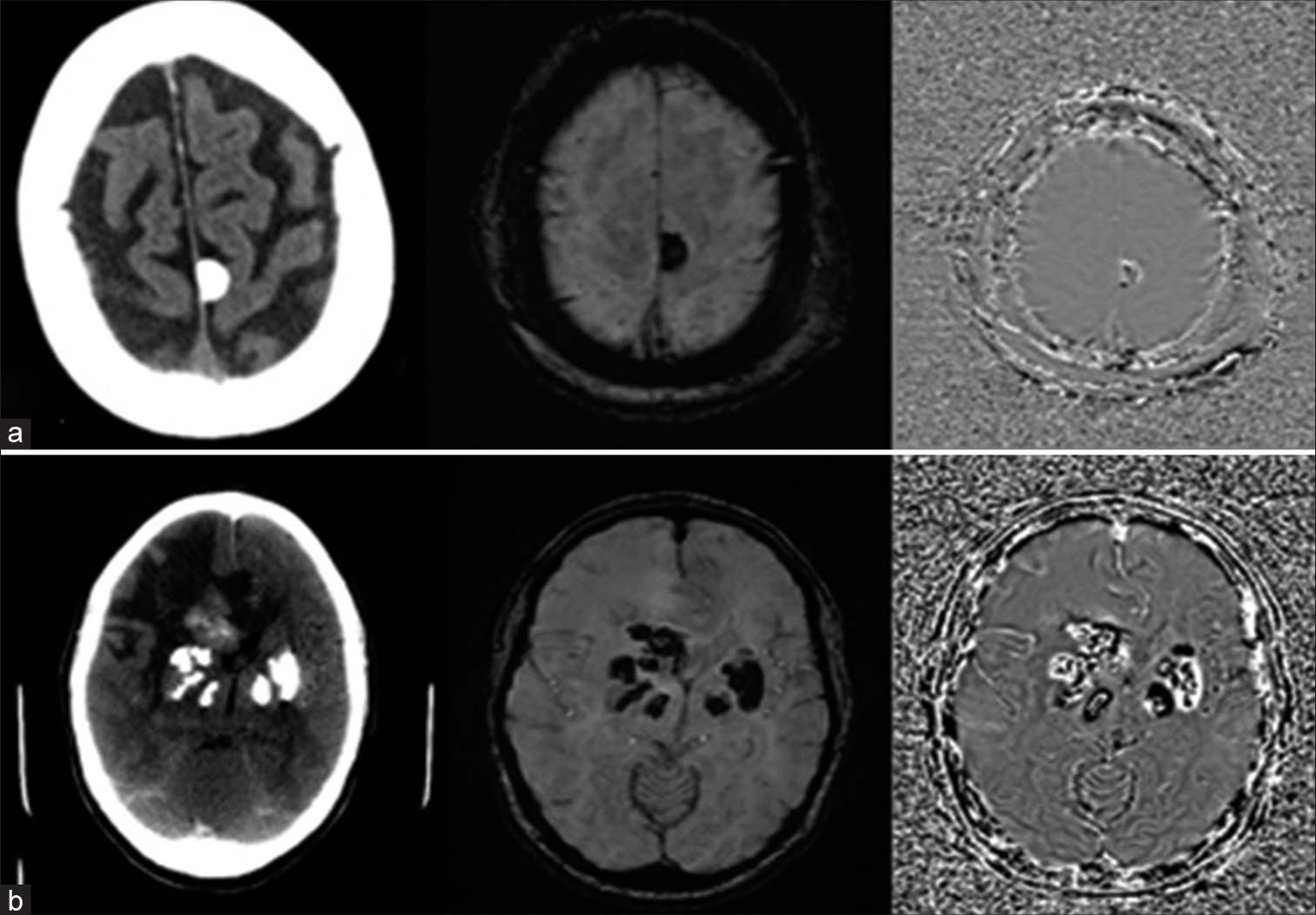 Axial computed tomography (CT) and magnetic resonance imaging (susceptibility-weighted imaging [SWI] and Phase) images in two separate patients reveal hyperdensity on CT images and foci of blooming in SWI in both patients. Phase sequence reveals (a) hypointensity in the first patient due to calcium and (b) hyperintensity in the other patient due to non-heme iron. Note: The phase description is applicable to left-handed magnetic resonance scanners.