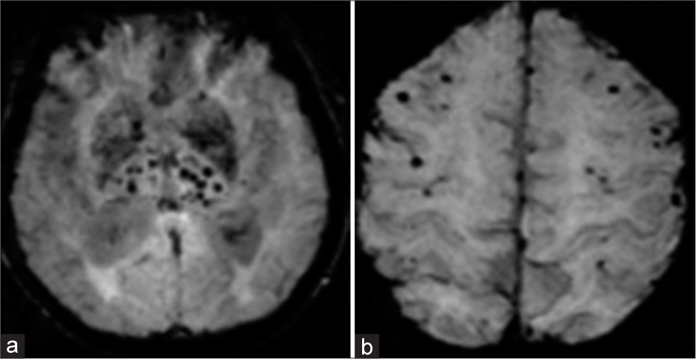 (a) Susceptibility-weighted images demonstrating cerebral microbleeds in the deep brain regions including basal ganglia, thalamus, and brainstem (b) in a case of hypertensive arteriopathy; peripheral lobar distribution in a patient with cerebral amyloid angiopathy.