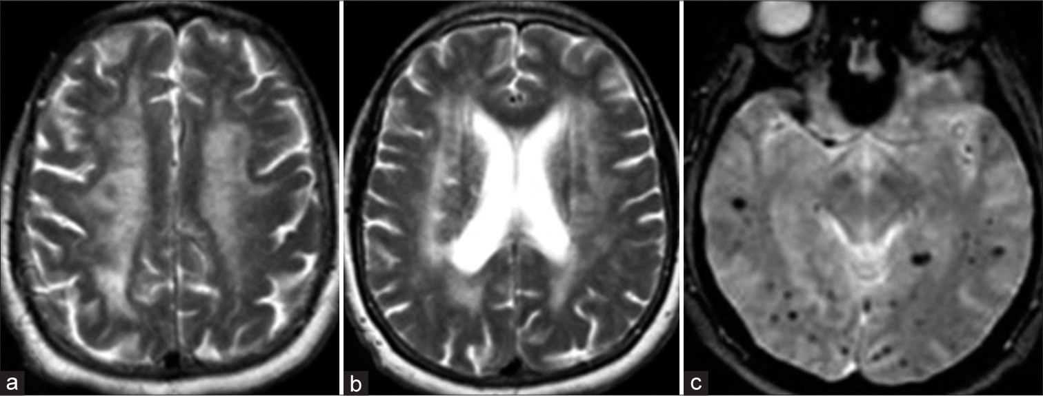 (a and b) Axial T2WI and (c) susceptibility-weighted imaging sequences in a 71-year-old male patient who presented with cognitive decline showing classical imaging findings of amyloidangiopathy (white matter changes with subcortical microhemorrhages).