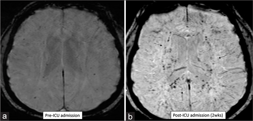 (a and b) Axial susceptibility-weighted imaging images reveal multiple tiny hemorrhages in the cerebral parenchyma during the indolent phase of acute lymphoblastic leukemia, while the computed tomography scan was negative for any bleeding.