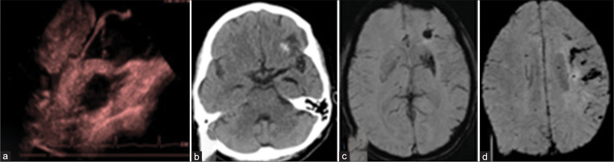 (a) Cardiac Doppler shows large left atrial myxoma. (b) Computed tomography, and (c and d) magnetic resonance imaging performed for the same patient with complaints of acute severe headache shows acute left frontal bleed with the left frontal subarachnoid hemorrhage.