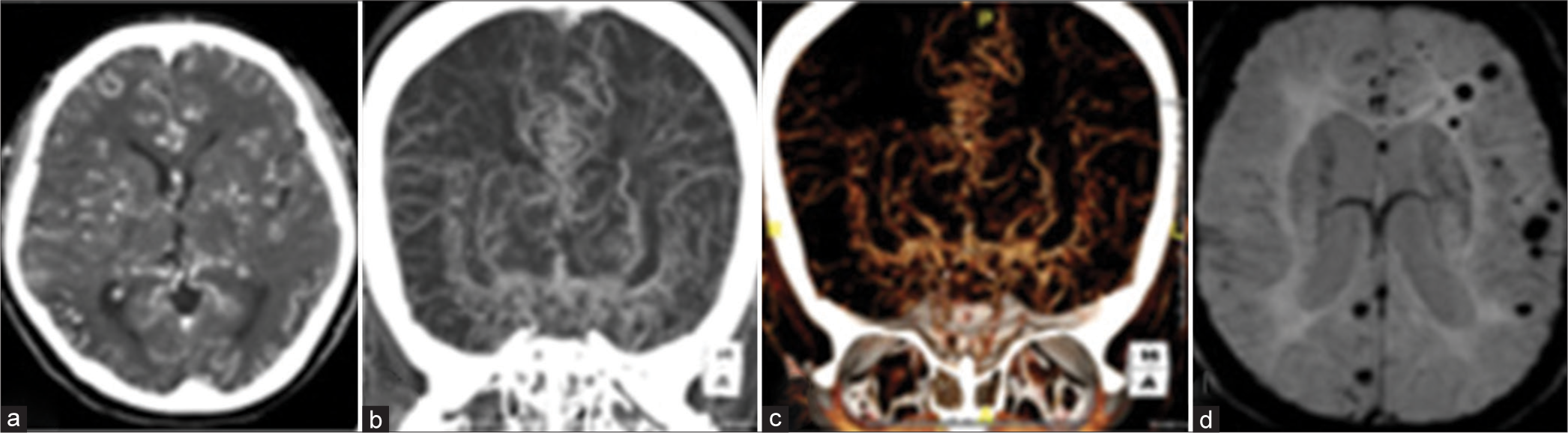 (a-c) Computed tomography angiogram of a 41-year-old female patient reveals extensive collateral formation throughout the cerebral parenchyma with severe narrowing of the terminal internal carotid arteries. (d) Susceptibility-weighted imaging revealed multiple tiny chronic hemorrhages. The patient was diagnosed with primary Moyamoya disease.