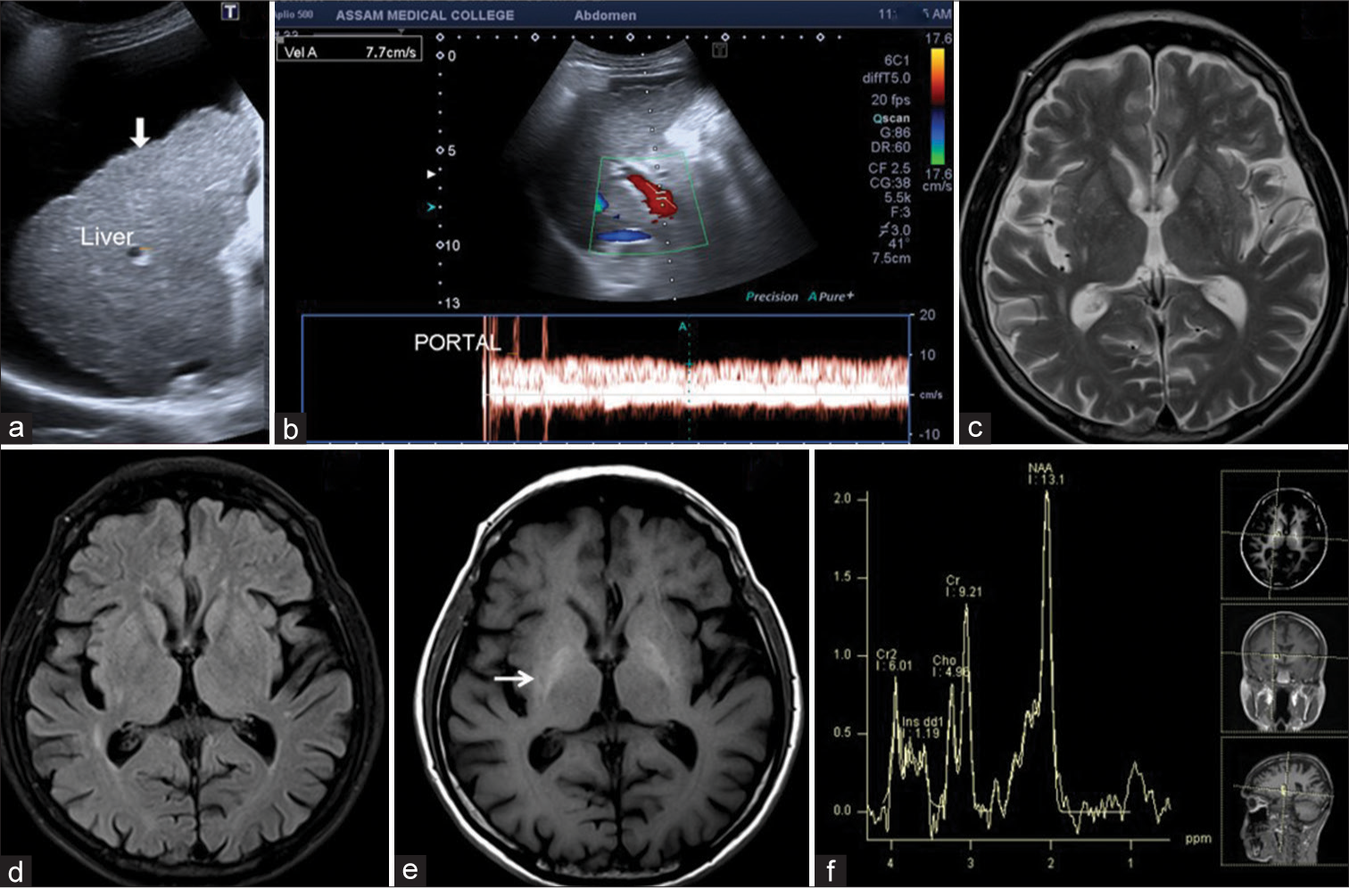 65-year-male patient with liver cirrhosis had mildly positive minimal hepatic encephalopathy. (a) USG image showed ascites with liver surface irregularities and nodularities (arrow). (b) Color Doppler image of portal vein flow velocity showed portal hypertension with a flow velocity of 7.7 cm/s. (c and d) Axial T2-weighted and fluid-attenuated inversion recovery images showed diffuse cerebral atrophy. (e) Axial T1-weighted image showed mildly T1 hyperintensities in the bilateral globus pallidi (arrow). (f) Low time of echo magnetic resonance spectroscopy showed a minimally raised Glx peak.