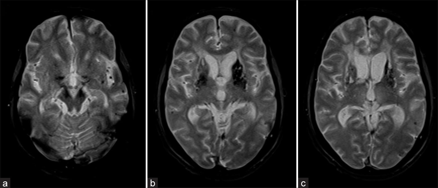 (a-c) The GRE T2* axial images at posterior fossa and basal ganglia level showing Grade II (6–10) deep and lobar microbleeds with the left putaminal old (macro) hemorrhage.