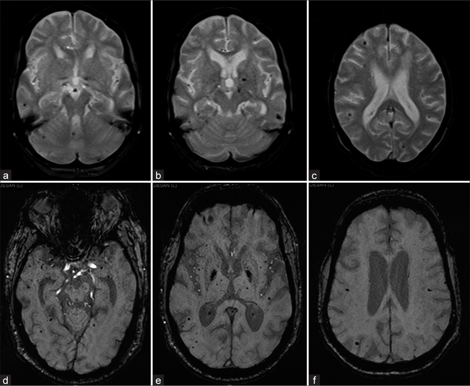 Two different patients with (a-c) GRE T2* axial and (d-f) susceptibility-weighted imaging axial images showing Grade III microbleeds of deep and lobar location.