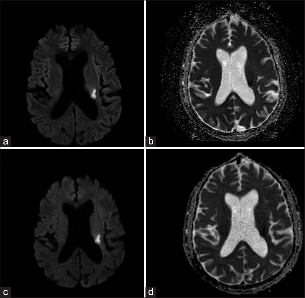 A 68-year-old male patient with acute stroke presenting with sudden-onset weakness of the right upper and lower limbs. (a) Conventional-DWI and (b) ADC, (c) EPIMix-DWI, and (d) ADC axial MR images show that the image quality is comparable, and the acute infarct in the left corona radiata is well seen on the EPIMix images. DWI: Diffusion-weighted imaging, ADC: Apparent diffusion coefficient, EPIMix: Echo-planar imaging mix, MR: Magnetic resonance.