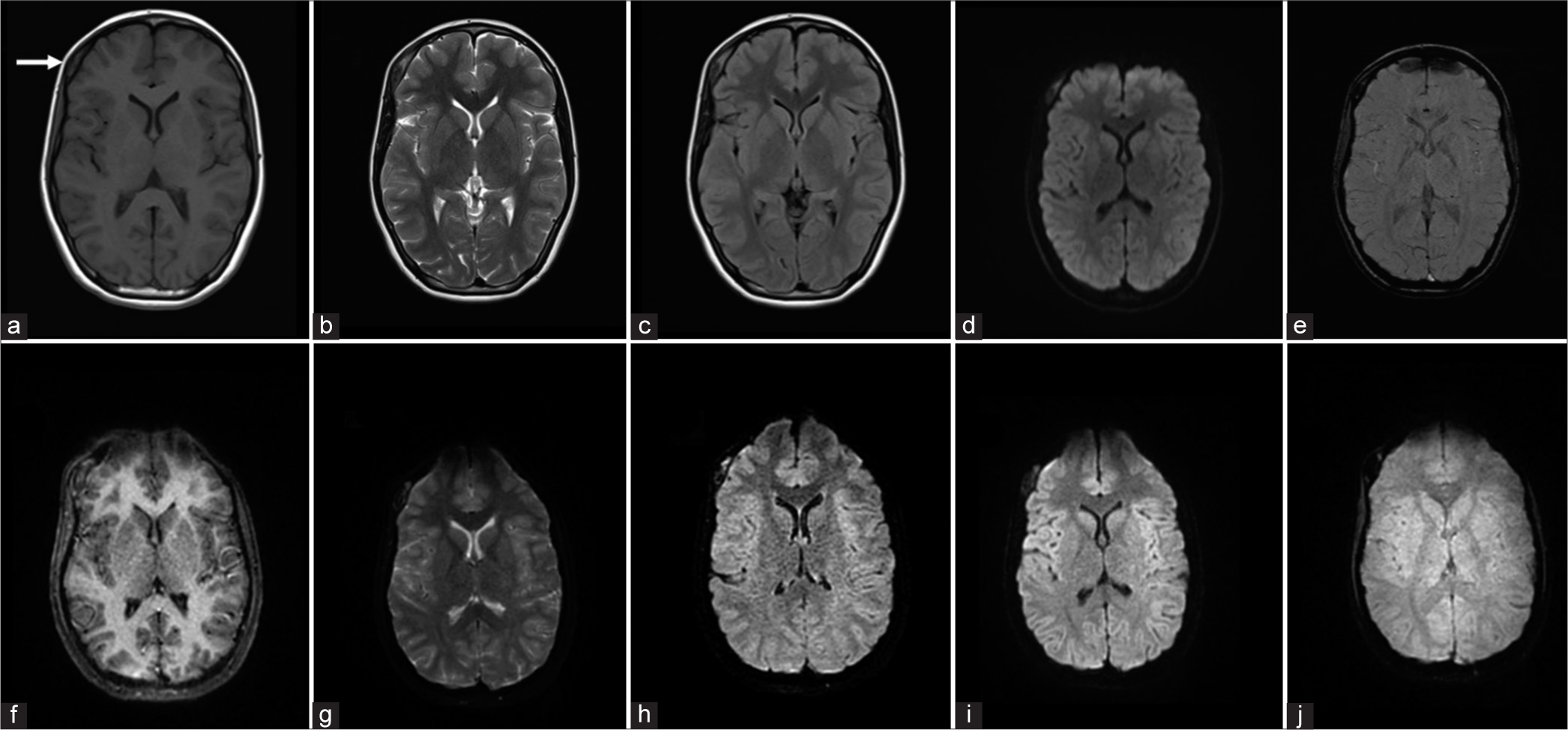 A 14-year-old female patient with a right frontal calvarial lesion presenting with a swelling in the forehead on the right side. Conventional MR [(a) T1W, (b) T2W, (c) FLAIR, (d) DWI, and (e) SWAN] and EPIMix axial images [(f) T1W, (g) T2W, (h) FLAIR, (i) and (j) T2*] show the right frontal calvarial lesion (white arrow in a). Lesions of the skull base, calvarium, and orbit are more difficult to visualize on EPIMix images. T1W: T1 weighted, T2W: T2 weighted, FLAIR: Fluid-attenuated inversion recovery, DWI: Diffusion-weighted imaging, EPIMix: Echo-planar image mix, SWAN: Susceptibility-weighted angiography, MR: Magnetic resonance.