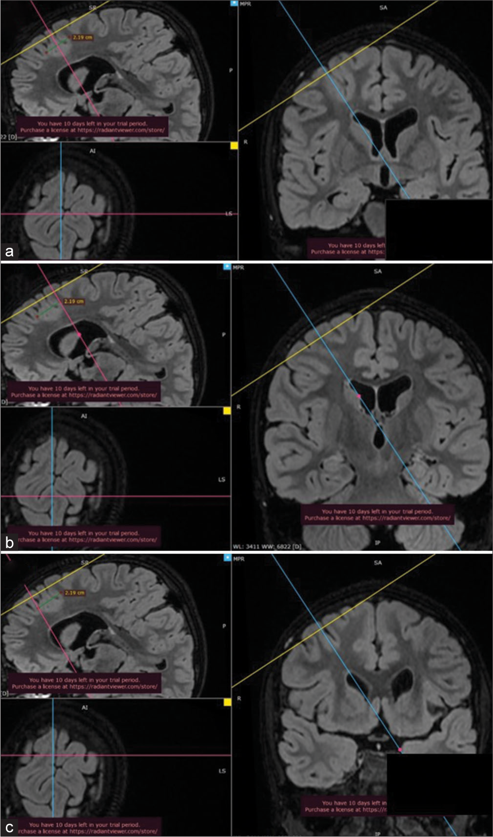 3D multiplanar reformation images of 3D fluid-attenuated inversion recovery magnetic resonance imaging sequences showing (a) hyper-intensity suggestive of focal cortical dysplasia in the right frontal lobe in which sagittal plane crossing through the center, (b) posterior, and (c) anterior limits of the lesion where the axial plane is showing the surface pattern of the brain with sulci and gyri.