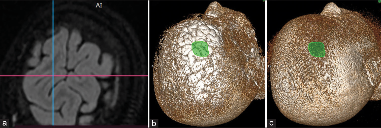 3D multiplanar reformation image where (a) axial plane showing a surface pattern of the brain with sulci and gyri, (b) 3D volume-rendering technique (VRT) localization of lesion (area marked in green) over similar appearing gyri and sulci of axial T2 fluid-attenuated inversion recovery, and (c) corresponding 3D VRT image of the scalp with a lesion (green area) projected on it.