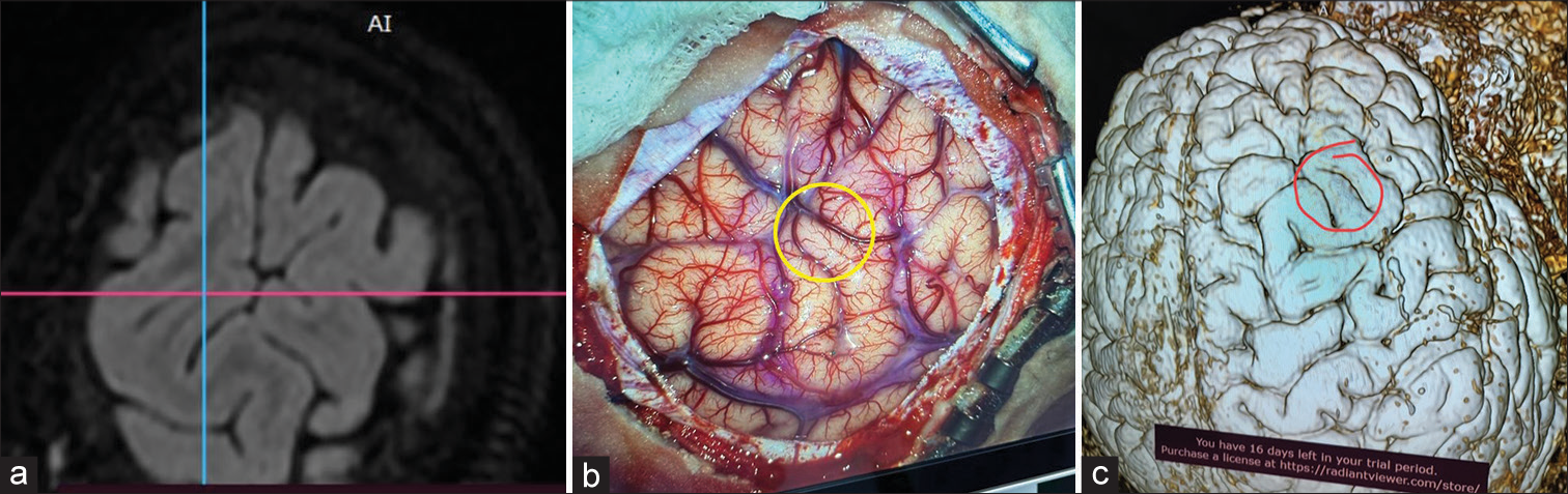 (a) Axial image of 3D multiplanar reformation fluid-attenuated inversion recovery (FLAIR) sequence of surface, (b) exposed brain over the area with lesion marked in a yellow circle, (c) where corresponding redline lesion area is marked similar to 3D volume rendering technique FLAIR image of the brain.