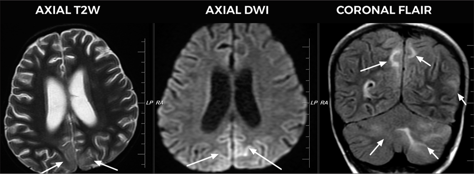 Five-year-old girl with intracranial non-germinomatous germ cell tumor of suprasellar region who presented with visual disturbances and altered sensorium, magnetic resonance imaging image shows bilateral symmetrical T2/fluid-attenuated inversion recovery hyperintensities (arrows) with subtle restricted diffusion is seen in bilateral parieto-occipital lobes and bilateral cerebellar hemispheres, suggestive of posterior reversible encephalopathy syndrome. In the coronal flair, bilateral optic nerve sheath complexes appear prominent with mild kinking of optic nerves, suggestive of raised intracranial tension.