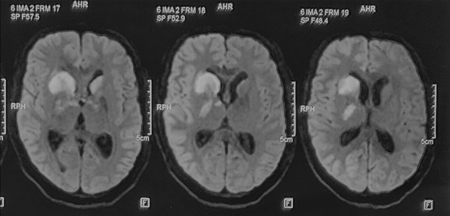 The magnetic resonance imaging brain diffusion-weighted images showing areas of diffusion restriction in “the tubercular zone” in head of caudate nucleus, anterior limb, and genu of internal capsule, anteromedial thalamus on the right and head of caudate nucleus on the left side after worsening of sensorium.