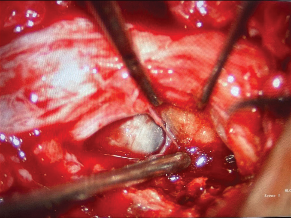 Intraoperative surgical excision of aneurysm.