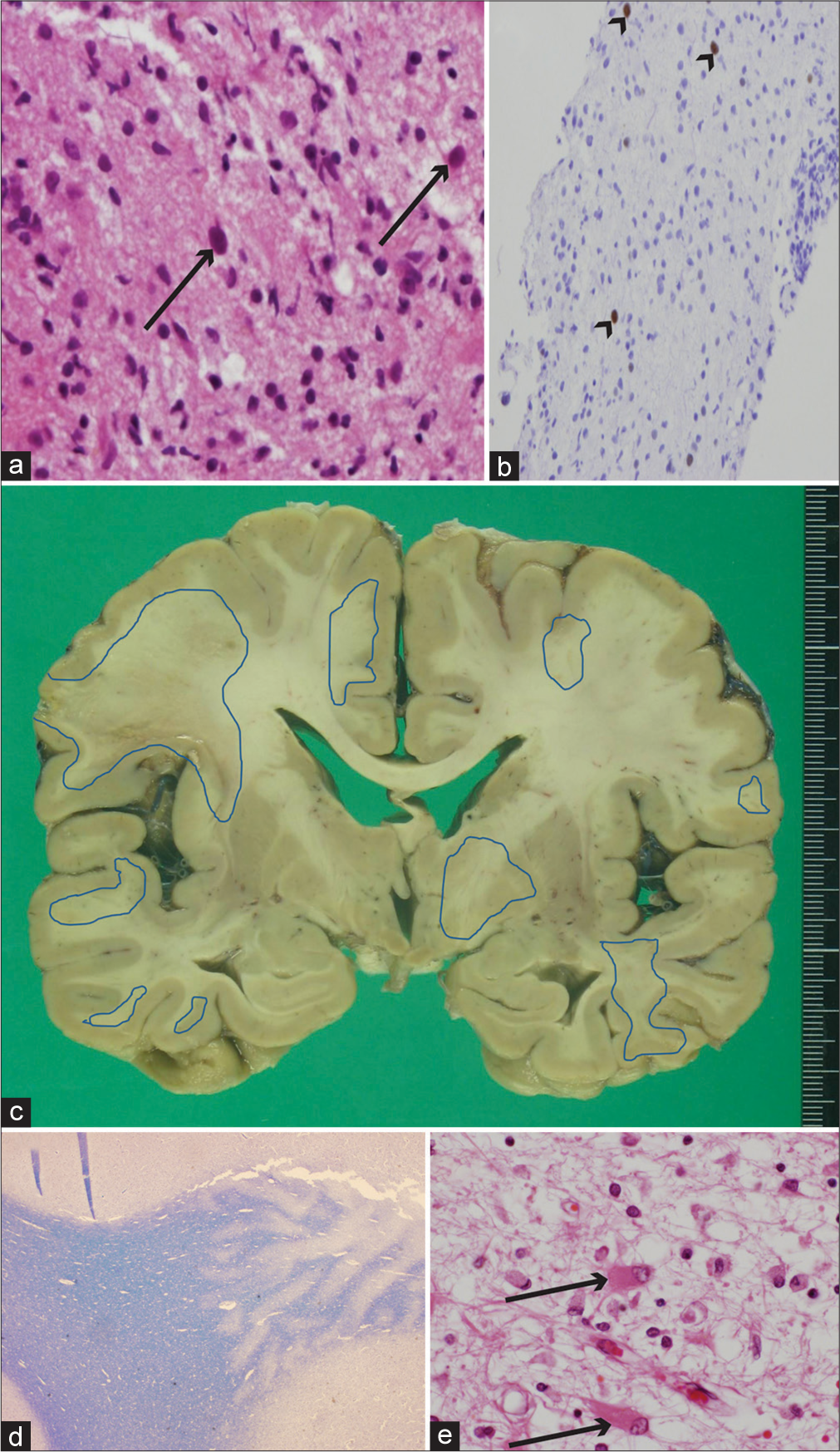 (a and b) Brain biopsy histopathological, and postmortem (c) brain and (d and e) histopathological findings. (a) Enlarged glial cell nuclei (arrows) can be seen in the background demyelination along with macrophage migration (hematoxylin and eosin [HE] staining, ×400). (b) Immunohistochemistry for the Simian virus 40 (SV 40) antigen showed positive findings for glial cell nucleoli (arrowheads) (SV 40 stain, ×200). (c) Postmortem image of coronal section of brain showing multiple foci with brownish pigmentation, predominantly in subcortical white matter. Regions encircled with blue lines indicate histologically proven demyelination lesions. (d) Gross findings of demyelination in subcortical white matter (right side of panel) (Kluver-Barrera staining, ×12.5). (e) Arrows show glial cells with eccentric enlarged nuclei in eosinophilic cytoplasm (HE staining, ×400).