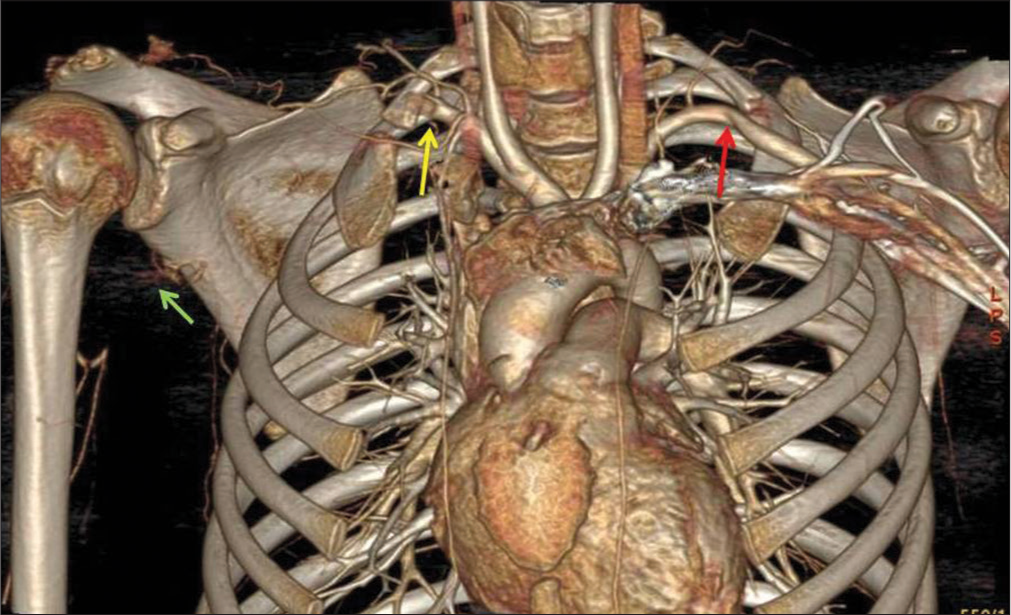 Three-dimensional volume-rendered computed tomograph angiographic image showing occlusion of right subclavian artery (yellow arrow) below the cervical rib, collaterals in the arm (green arrow), and mild narrowing of left subclavian artery (red arrow).