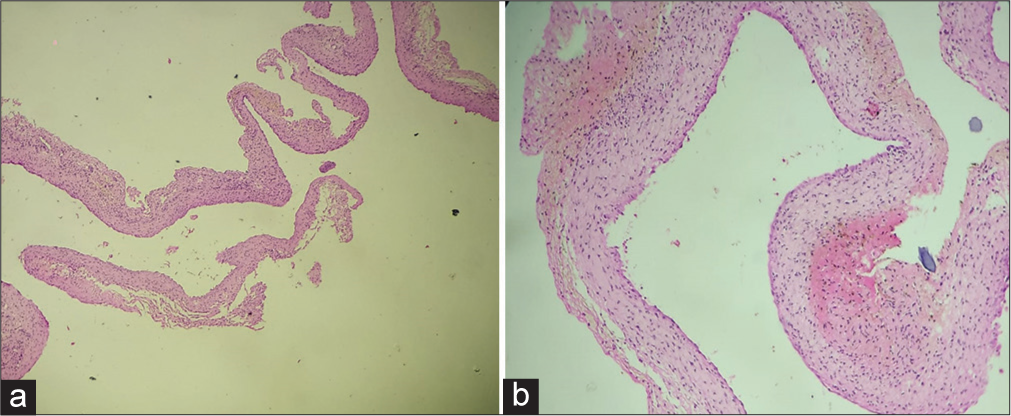 Histopathological images showing fibrocollagenous tissue with cuboidal to columnar epithelial lining suggestive of arachnoid cyst in (a) low-power and (b) high-power fields.