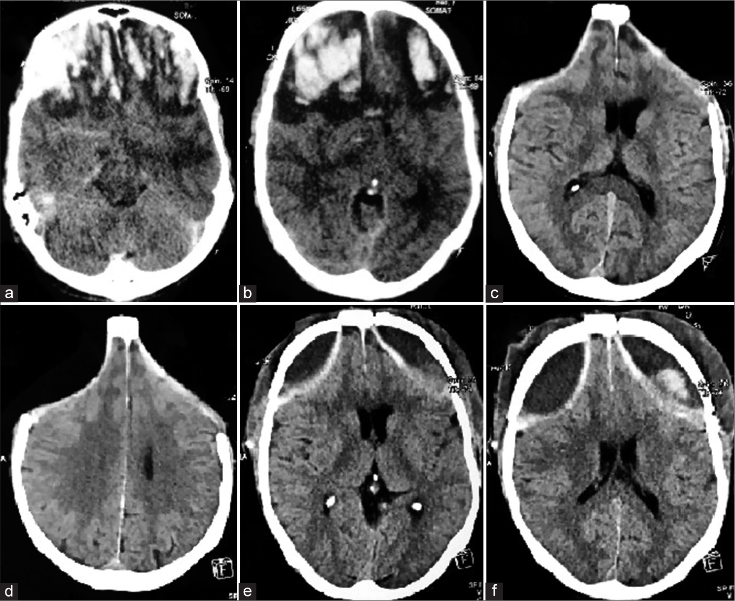 (a and b) Axial computed tomography (CT) scan images of a patient with bifrontal contusions showing effaced cisterns and ventricles with significant perilesional edema, who subsequently underwent bilateral decompressive craniectomy. (c and d) Axial CT images show that precranioplasty the scalp flap was sunken bilaterally. In this patient, no neodural hitch sutures had been placed, and (e and f) axial CT images done on the morning after surgery show a significant post-operative collection below the replaced flap on both sides.