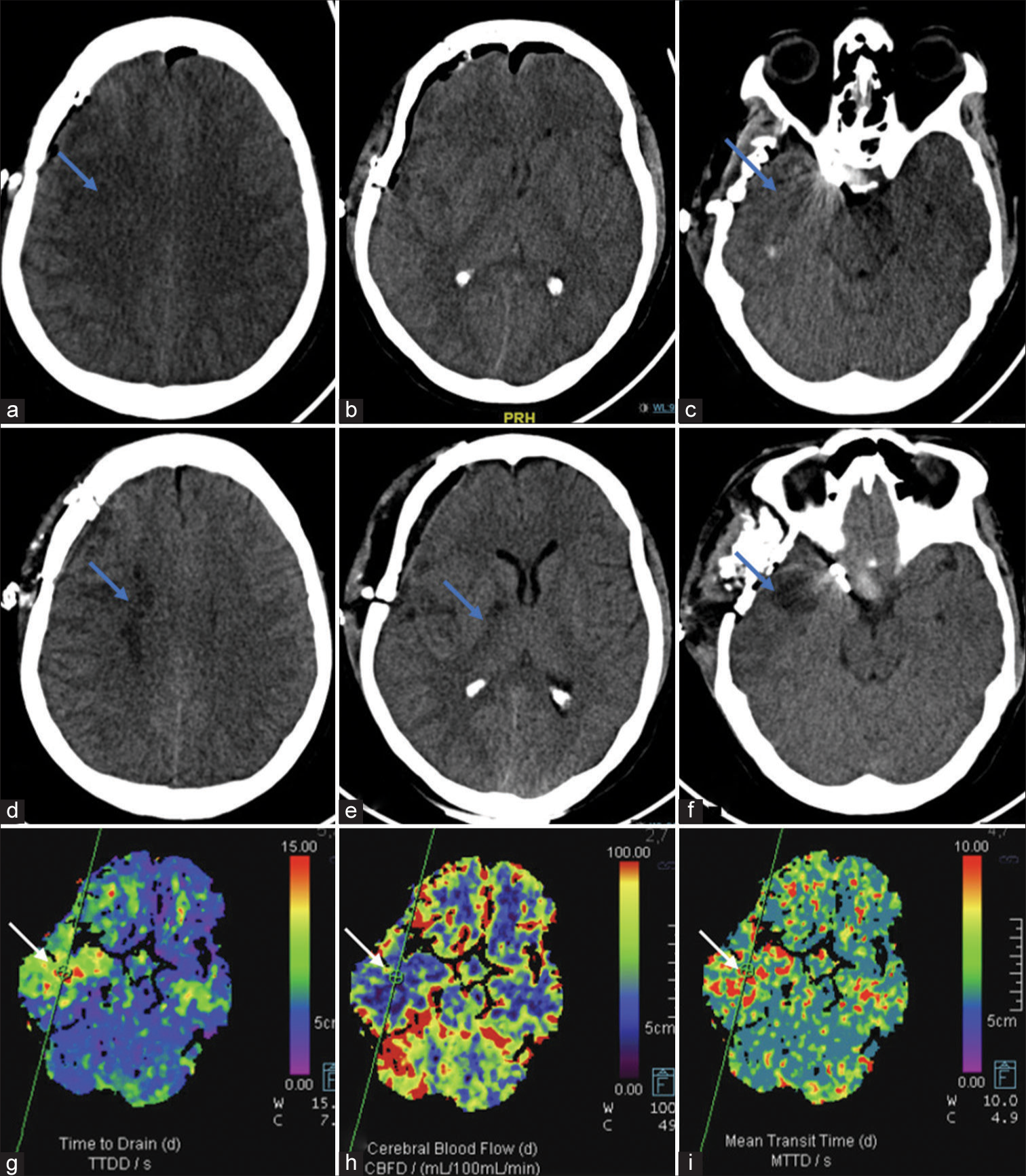 Findings of Case 2: (a-c) Day 1 post-clipping non-contrast computed tomography (NCCT) shows right pterional craniotomy with pneumocephalus. Subtle hypodensities (blue arrows) are seen in the right frontal lobe and anterior temporal lobe. (d-f) Day 4 patient developed left upper limb and lower limb weakness and repeat NCCT shows well-developed infarcts (blue arrows) in the right internal watershed zone, posterior limb internal capsule and anterior temporal lobe. (g-i) Concomitant computed tomography perfusion was performed, which revealed markedly decreased cerebral blood flow, increased time to drain, and mean transit time indicative of infarcted tissue (blue arrows).