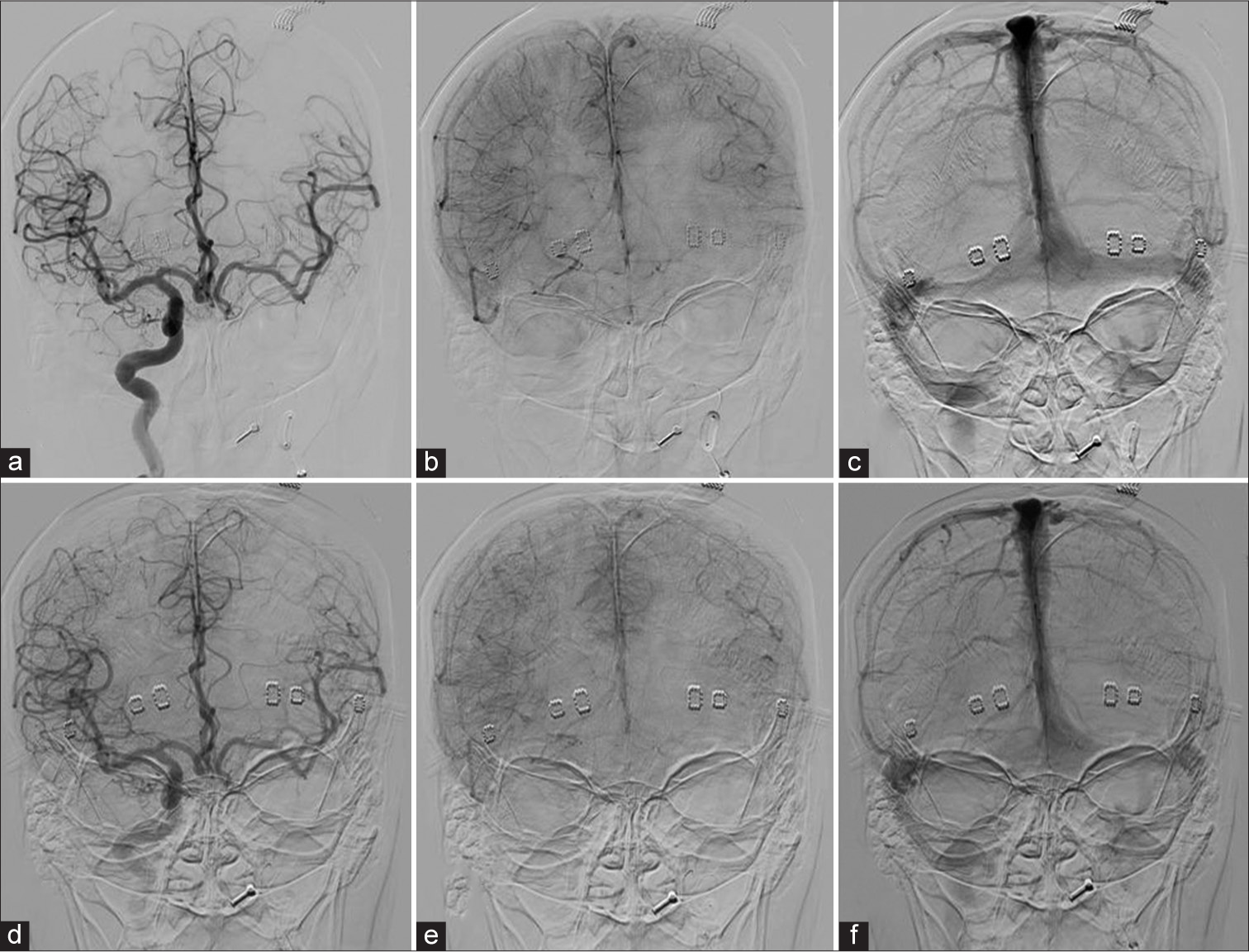 Venous phase assessment of case 9: (a) Angiogram AP view, injected by right ICA shows arterial phase. (b and c) Early and late venous phases, respectively, demonstrate perfect synchronous venous filling of the left hemisphere through Acom. (d) The arterial phase of the injection through right ICA during hypotensive challenge demonstrates excellent cross-filling through Acom. (e and f), Early and late venous phases, respectively, show symmetry of venous filling of left ACA and MCA territories. ICA: Internal carotid artery, Acom: Anterior communicating artery, ACA: Anterior cerebral artery, MCA: Middle cerebral artery.