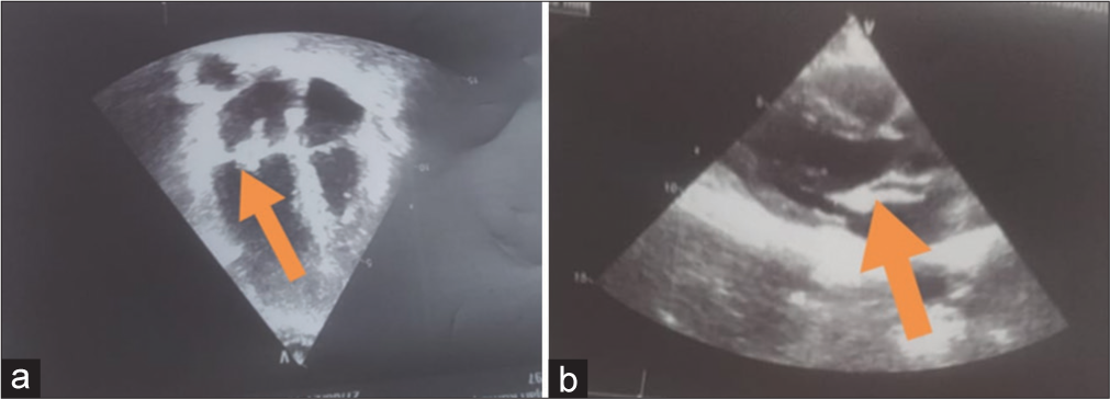 2D Echocardiography of the heart reveals a mobile vegetation on the anterior leaflet of mitral valve in (a) Apical four chamber view (Orange arrow) and (b) Parasternal long axis view (Orange arrow).