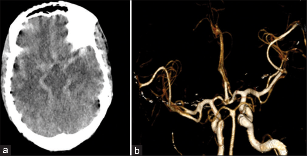 (a) Axial non-contrast computerized tomography head showing diffuse hyperintensity in basal cisterns as well as in the cortical sulcal spaces, appearing as subarachnoid hemorrhage. (b) 3D Recon volume-rendering technique images of computed tomography angiogram showed normal vessels.