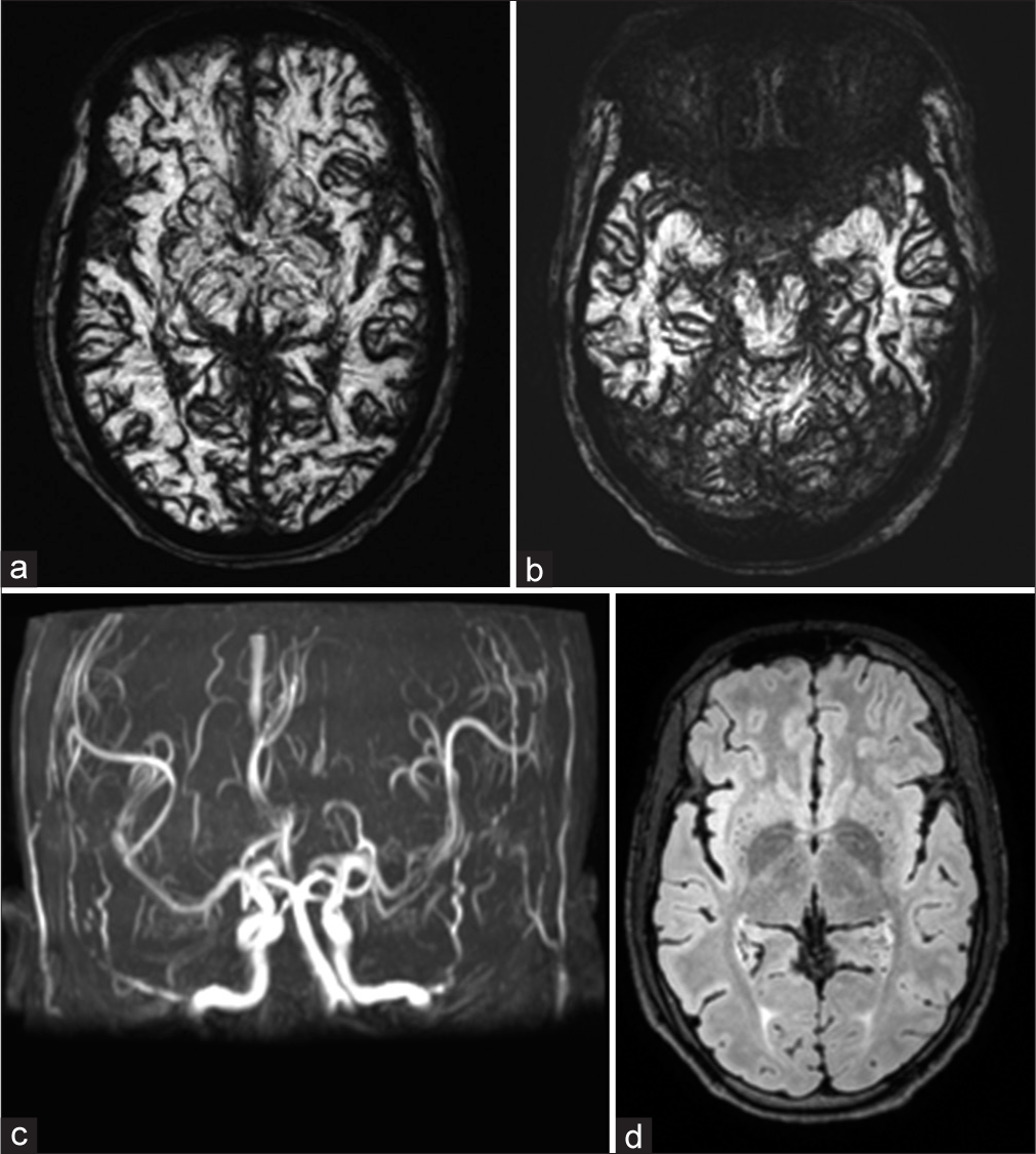 (a and b) Susceptibility-weighted imaging sequence of magnetic resonance imaging brain shows diffuse blooming in the sulcal spaces and basal cisterns of bilateral cerebral hemispheres and cerebellar folia. (c) MIP magnetic resonance angiography (MRA) TOF and contrast-enhanced MRA sequences revealed normal intracranial vessels without any evidence of aneurysm or arteriovenous malformations. (d) Fluid-attenuated inversion recovery sequence revealed the absence of hyperintensities in sulcal spaces and basal cisterns, respectively, ruling out the presence of subarachnoid hemorrhage.