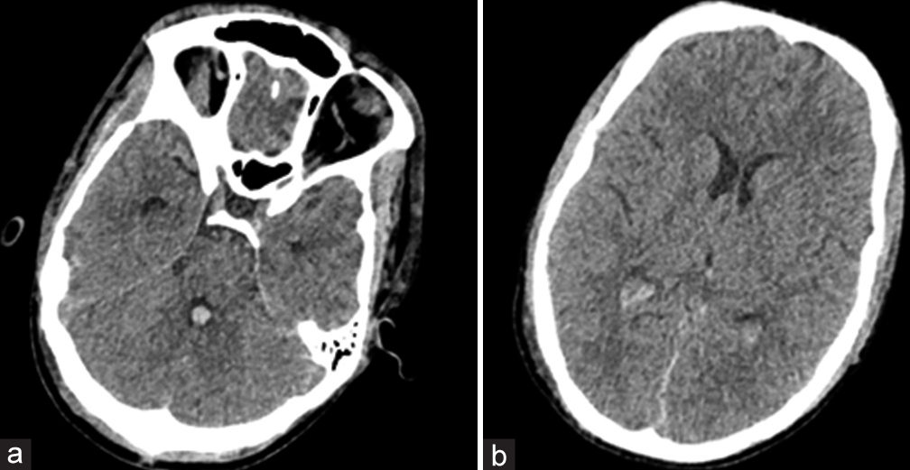 (a) Repeat non-contrast computerized tomography head after central shunt depicted resolution of hyperdensities in the basal cisterns and the presence of a small amount of intraventricular hemorrhage (IVH) in the fourth ventricle. (b) A small amount of IVH also was noted in the bilateral occipital horns of the lateral ventricle.