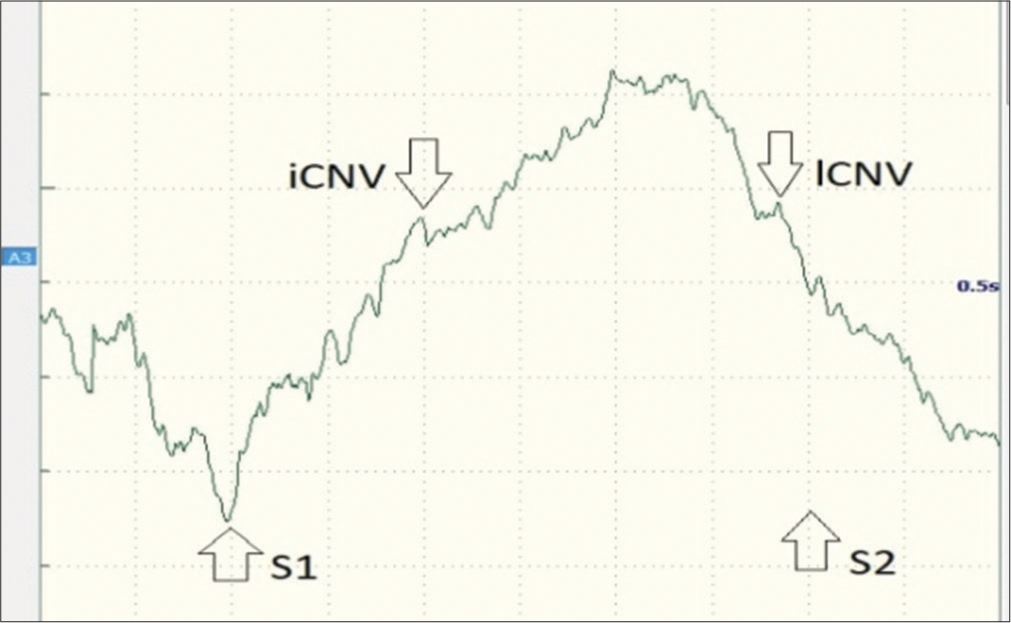 CNV waveforms that were recorded in a study participant showing iCNV, lCNV, and the onset of S1 (warning stimulus; auditory click) and S2 (imperative stimulus; auditory burst). CNV: Contingent negative variation, iCNV: Initial contingent negative variation, lCNV: Late contingent negative variation.