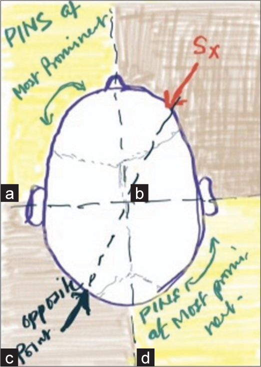 Line diagram showing four quadrants of head with example of planning right pterional craniotomy. Pin applications should be done in adjacent quadrant to the area of interest (Sx). (a) Left anterior quadrant – site of application of single, non-dependent pin. (b) Right anterior quadrant – surgical area. (c) Left posterior quadrant (opposite quadrant) – no pins should be applied on the opposite quadrant. (d) Right posterior quadrant – site of application of two dependent pins. PINS: Pins of head frame, Sx: Surgical site.