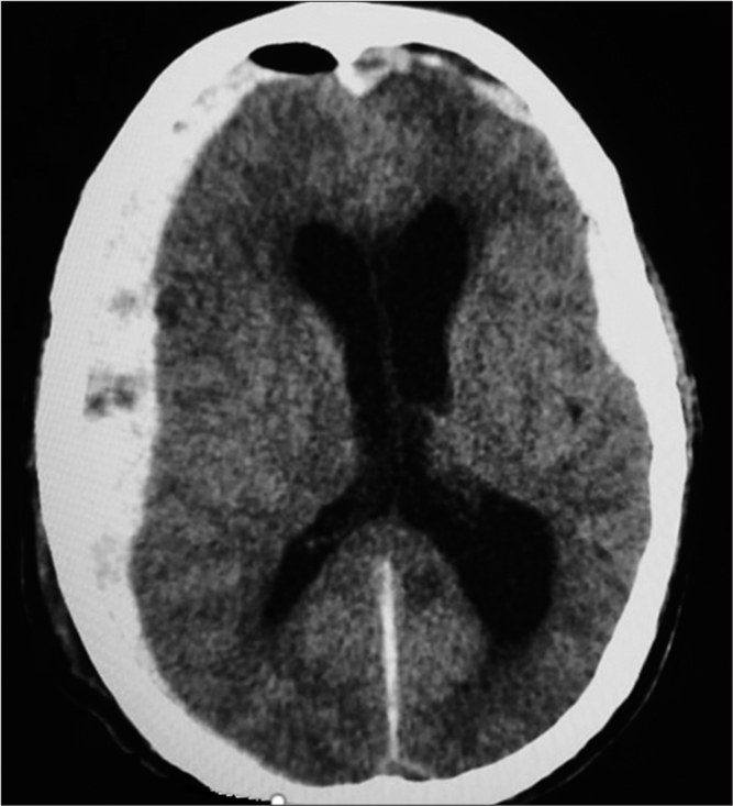 Axial computed tomography scan of head showing bilateral acute subdural hematoma (left more than right) with ventricular dilatation in a post-operative patient of the right cerebellopontine angle epidermoid due to pin of head clamp (Sugita head frame)