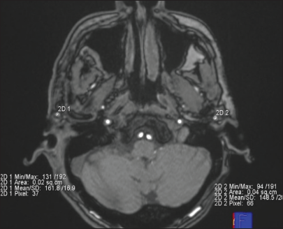 An axial post-operative time-of-flight magnetic resonance angiography image of a patient who underwent right superficial temporal artery (STA)-middle cerebral artery anastomosis is shown. Bilateral regions of interest are manually placed on STA just proximal to its bifurcation. The mean signal intensity is shown in the bottom right and left of the image.