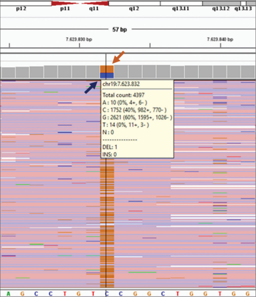 The next-generation sequencing profile of the PNPLA6 (NM006702.5) gene for one of the parents (Father). Heterozygous missense point mutation of c.3380C>G (p.Ser1127Cys) in exon 31 of PNPLA6 was detected for his father, blue arrow indicates wild C base (normal) in 40% and the brown arrow indicates G base (heterozygous mutated). It shows 60%. Both parents were carriers for the transversional point mutation at codon 376 of exon 31 for the PNPLA6 gene located on chromosome 19p13.2 for the current proband case.