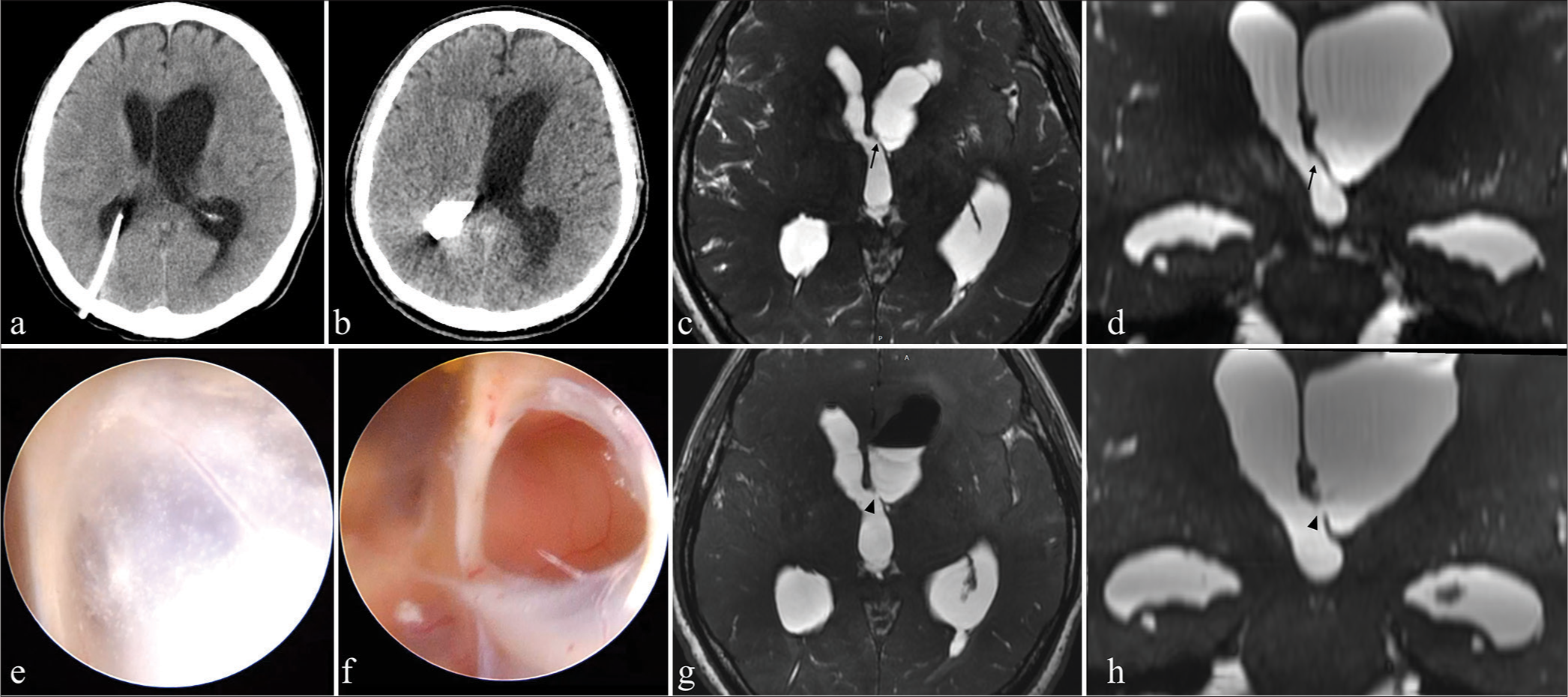 (a) Two months later, computed tomography (CT) revealed enlargement of only the left lateral ventricle. (b) CT after shuntography showed contrast filling the right lateral ventricle but not the left. (c) The axial and (d) coronal view of heavy T2-weighted images from magnetic resonance imaging (MRI) revealed a membranous structure at the left foramen of Monro (arrow). (e and f) We diagnosed unilateral hydrocephalus due to membranous occlusion of the left foramen of Monro, and endoscopic septostomy and foraminoplasty were performed. (g) Postoperative axial and (h) coronal view of MRI showed that membrane of the foramen of Monro was fenestrated (arrowhead).