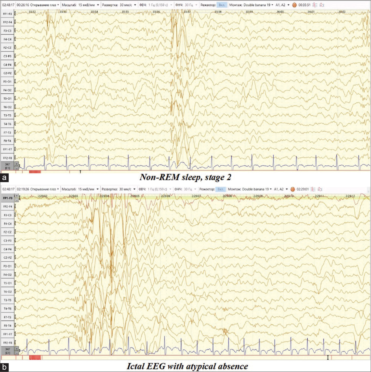 Video electroencephalogram daytime sleep monitoring dated September 20, 2023. (a) Non-REM sleep, stage 2. Short diffuse discharges of complexes spike/double spike-slow wave with amplitude predominance over the frontal-central leads, passing into generalized discharges. (b) Ictal EEG: Complexes spike/double spike/polyspike-wave above the temporal leads bilaterally asynchronously with the capture of the frontal-central leads, followed by registration of a short bilateral synchronous discharge of high-amplitude complexes spike/double spike-slow wave with a frequency of 2–2.5 Hz., clinically accompanied by a short fading with a slow lowering of the head and body forward for up to 2 s.