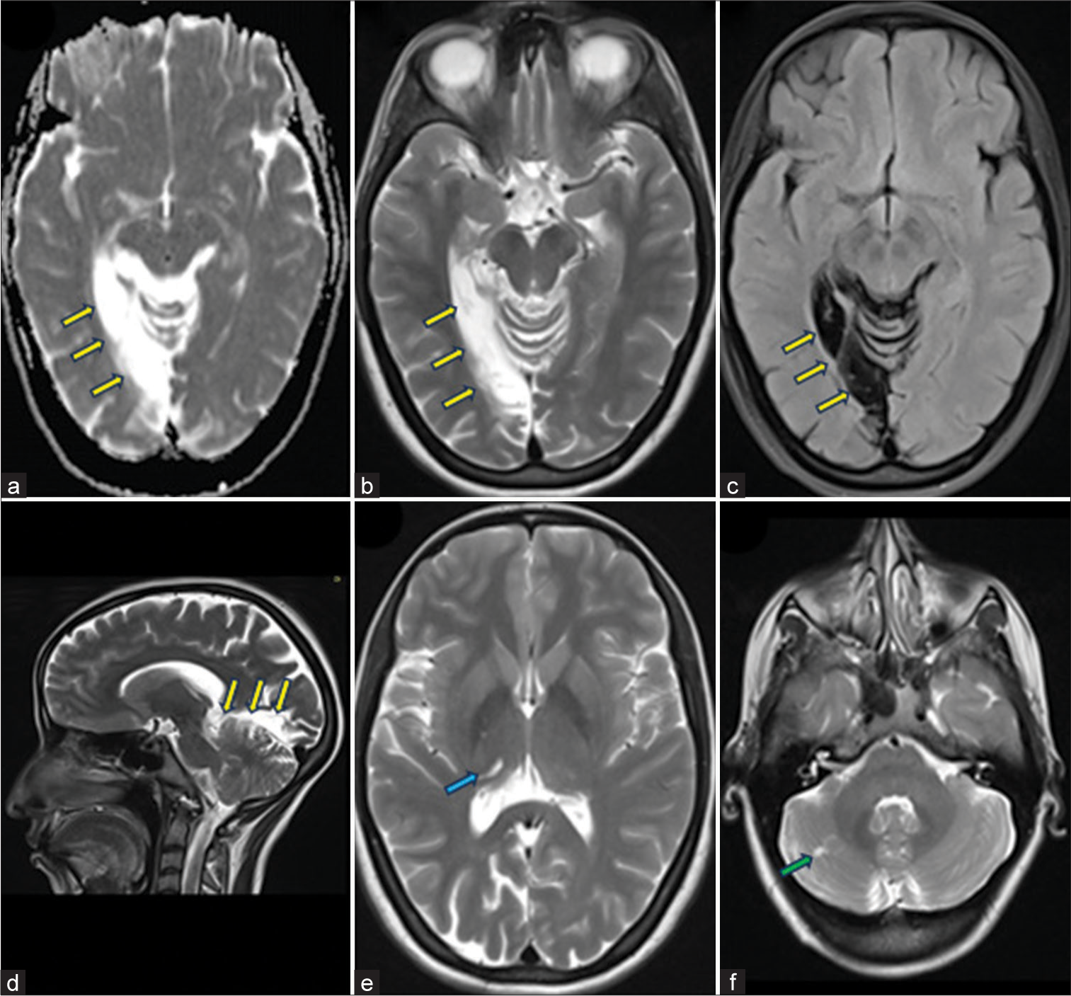 (a-c) Axial and (d) Sagittal MRI brain showing chronic infarct in the right occipitotemporal gyrus (yellow arrows), corresponding to location of optic radiation. (e-f) Axial MRI brain showing a chronic lacunar infarct in right hemi-thalamus (blue arrow) and in right cerebellar hemisphere (green arrow). Presence of multiple infarcts raised the possibility of embolic etiology.