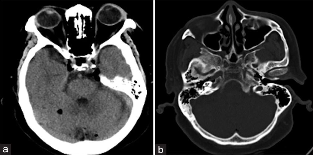 (a) Non-contrast computed tomography head showing multiple air locules in bilateral cavernous sinus, cerebellar folia, and right anterior temporal lobe. (b) Base of skull shows no fracture.