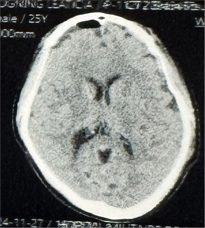 Non-contrast brain computed tomography scan at 1-month postoperative follow-up showing complete resolution of the subdural collections.