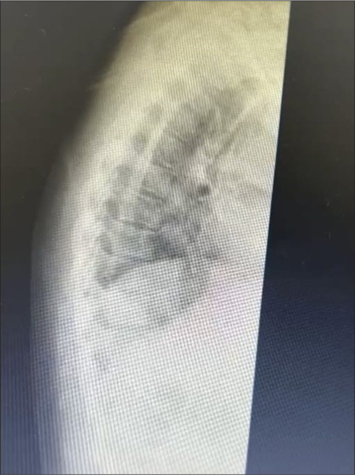 Case 1 - Lateral view of the thoracic spine, illustrating facet joint involvement.