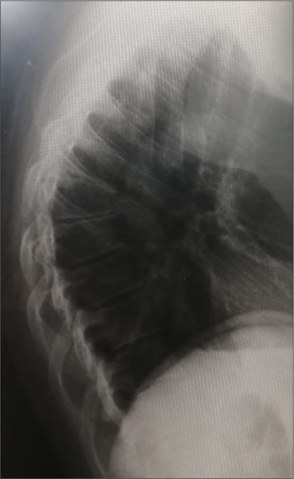 Case 2 - Lateral view of the thoracic spine, demonstrating the degenerative osteophyte changes.