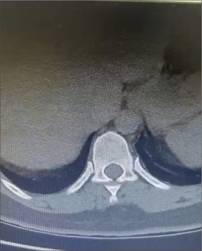Case 2 - CT thoracic spine, providing a detailed assessment of the bony structures.